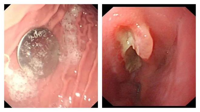 家长们注意!幼儿误吞纽扣电池10小时食道被腐蚀穿孔